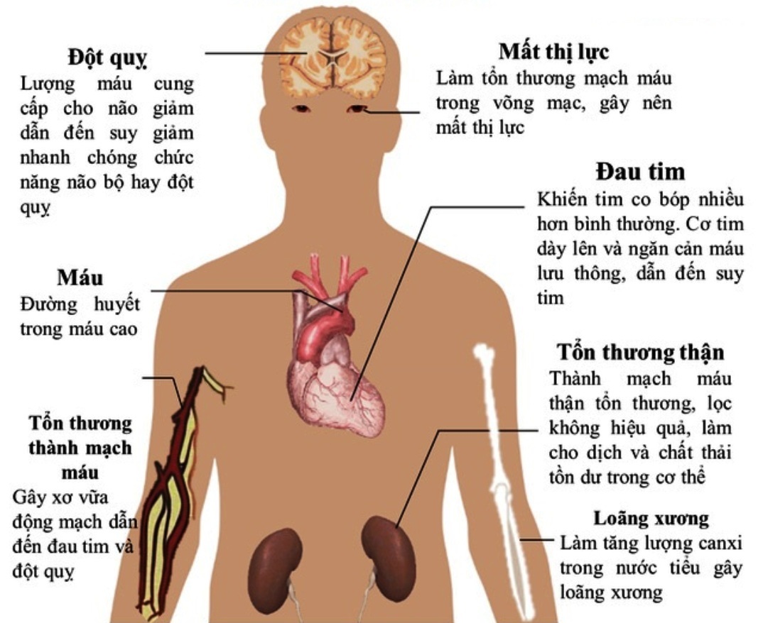 Huyết Áp Cao Nguy Hiểm Như Thế Nào: Nguyên Nhân, Triệu Chứng Và Cách Phòng Ngừa